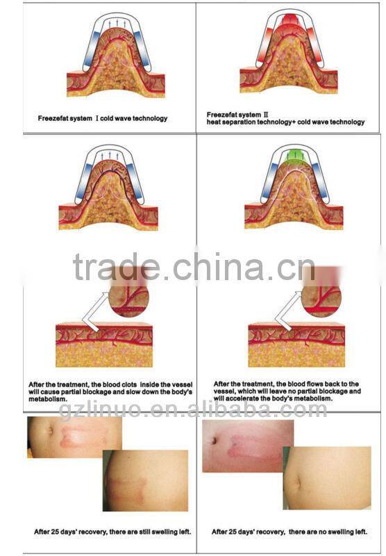 Chinese supplier wholesales 4 handles cryolipolysis machine