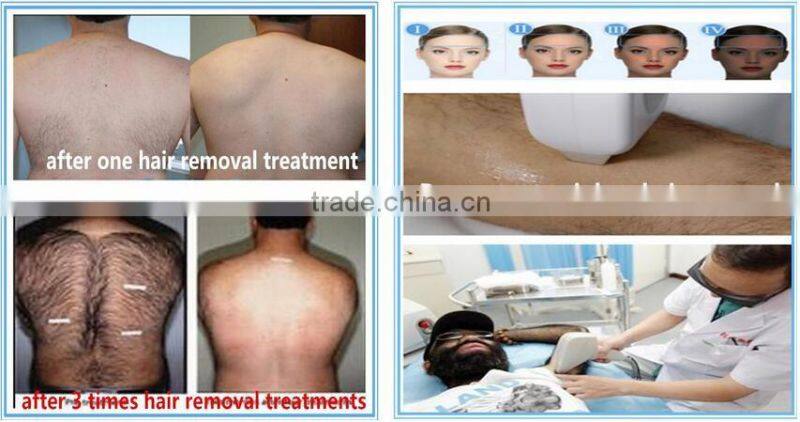 distributor wanted europe 808nm diode laser hair removal speed 808