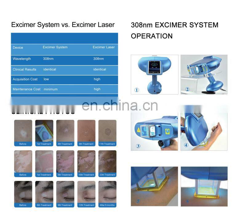 Handheld Excimer Laser 308Nm Psoriasis Vitiligo Laser Unit uv lamp vitiligo For Vitiligo Treatment