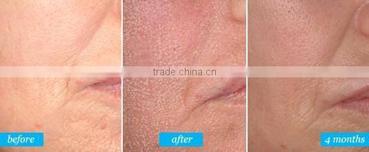 er yag laser Skin Rejuvenation scar removal machine Erbium laser remove chloasma CO2 laser