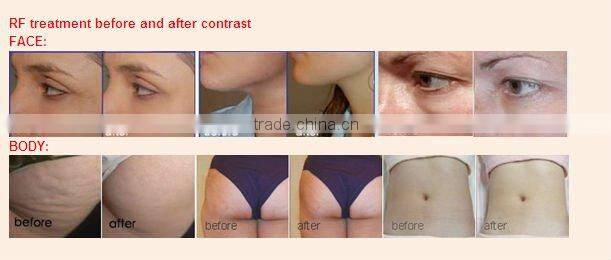 Ultrasonic Cavitation+Monopolar RF+Tripolar RF+Vacuum Liposuction 5 in 1 Beauty Machine-B005