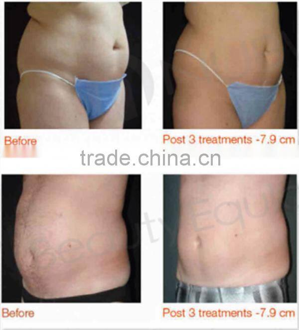 Non-invasive Fat Cell Destruction Fast Weight Loss HIFU Body Slimming Machine