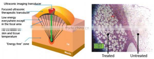 HIFU body shaping machine for weight loss centre