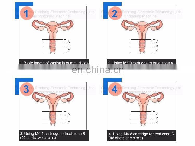 Non-invasive vaginal hifu tightening machine for women