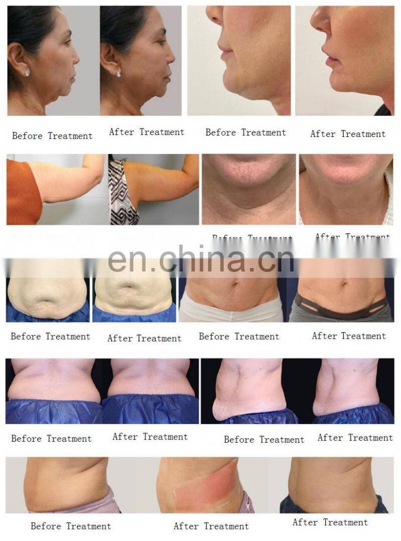 2022 Popular 10 Handles Hot Sculpting body shaping machine/ RF skin tightening machine/ Jisu ID fat dissolving machine