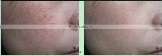 Pain Free skin mole removal machine
