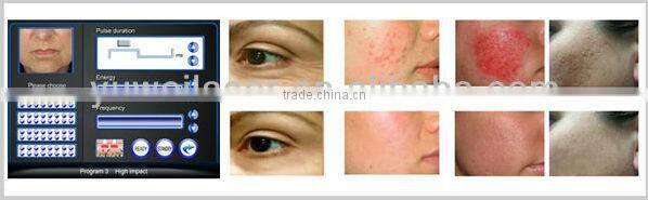 Hot Sale/fractional rf microneedles beauty machine