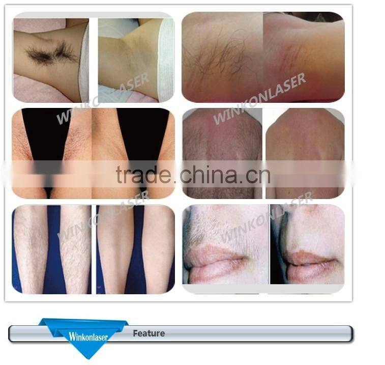 powerful and professional hair removal pad and hair removal prices