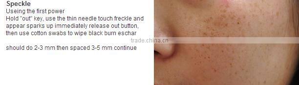 Plasma pen removal tattoo skin pen treatment tattoo removal pen