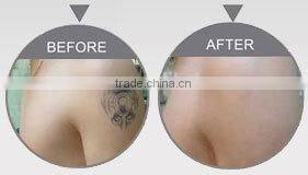 Medical Active EO Q Switch ND YAG/Dye Laser Tattoo Removal 585nm