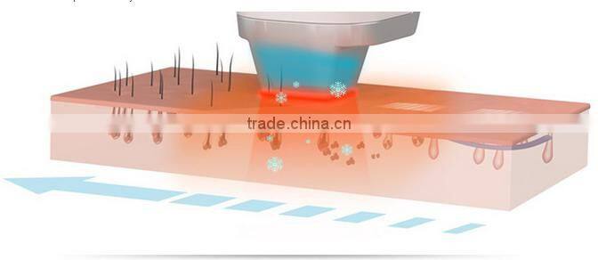 china suppliers ipl handpiece ipl shr laser