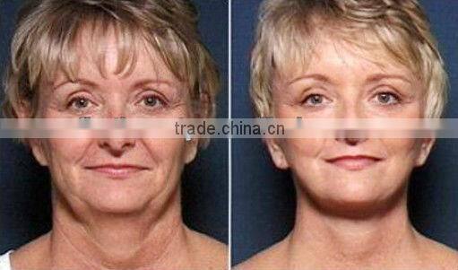 bequty salon use intense pulse light IPL for hair removal machine A003 beauty salon pigment removal skin rejuvenation machine