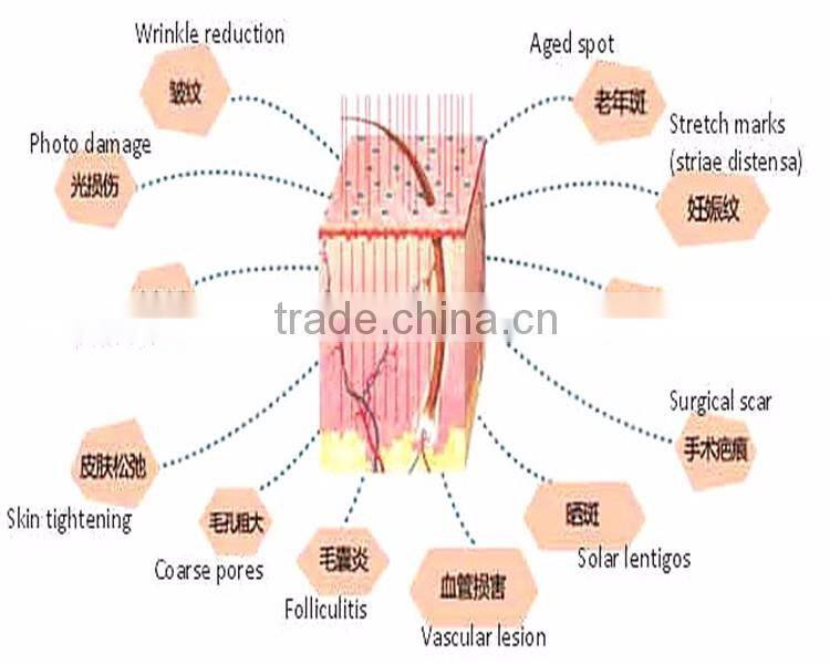 Super Popular Ultra Pulse Fractional Co2 Laser System