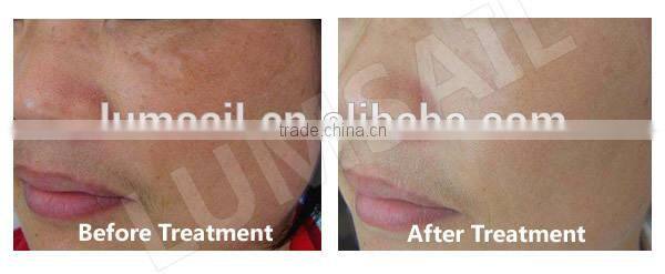 2014 New Arrival pdt led for whitening skin rejuvenation