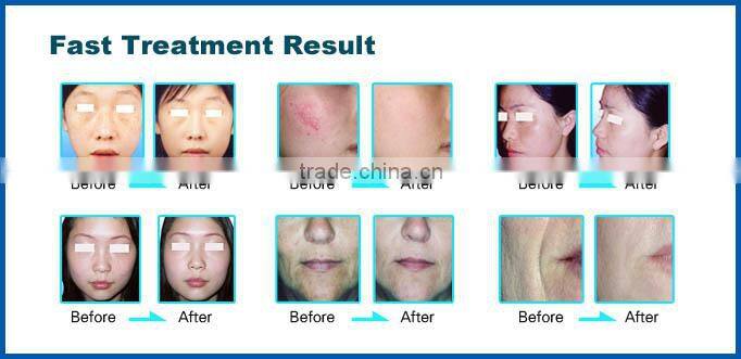 Weifang KM 8.4inch touch screen portable shr face spot remover face black spot remover machine