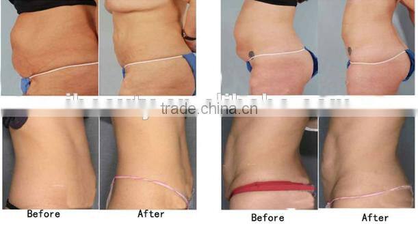 Cryotherapy fat freezing Cryotherapy equipment Cryotherapy machine for sale