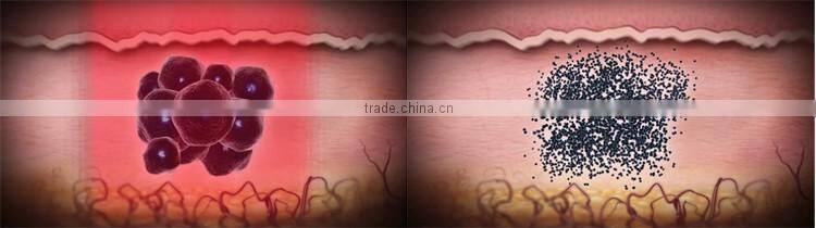 PicoSecond laser new laser for tattoo removal pigment removal