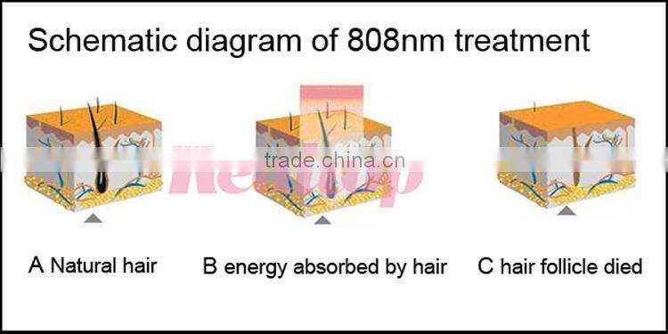 NEW HOT!!! 2016 Worldwide Distributors Wanted Promotional Quick Lead Cheap Diode Laser Hair Removal 808nm SHR IPL Hair Removal