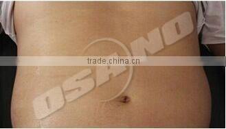 Osano Portable Cool Body Shaping Cryolipolysis Machine For Home Use