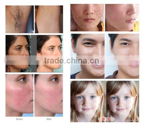 ipl machine home use/hair removal laser machine prices A006