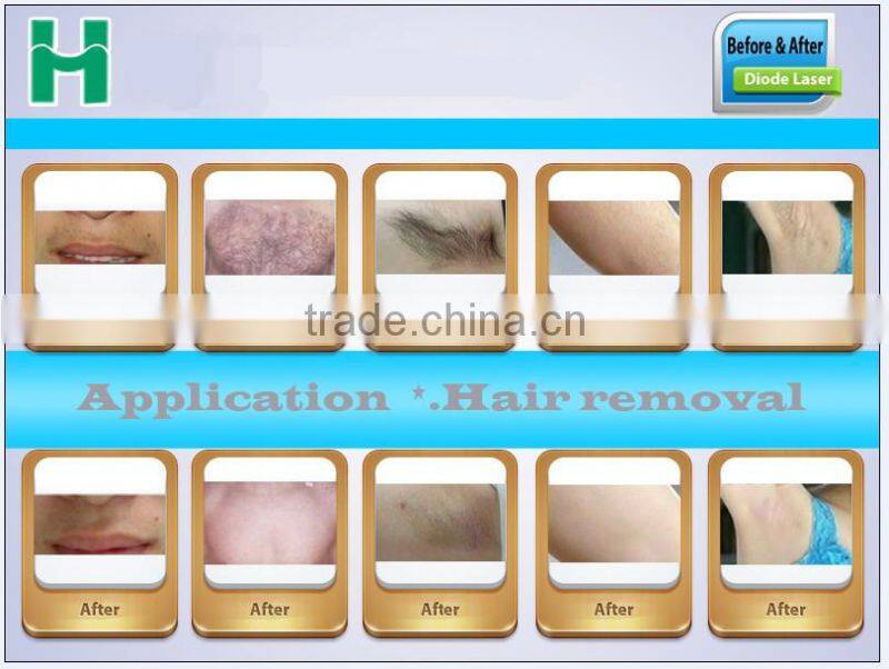 808nm Diode Laser Machine for Fast & Painless Hair Remvoal