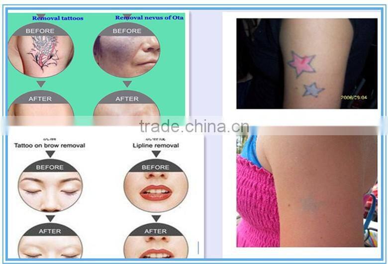 q switch nd yag laser / tattoo removal machine / laser tattoo removal