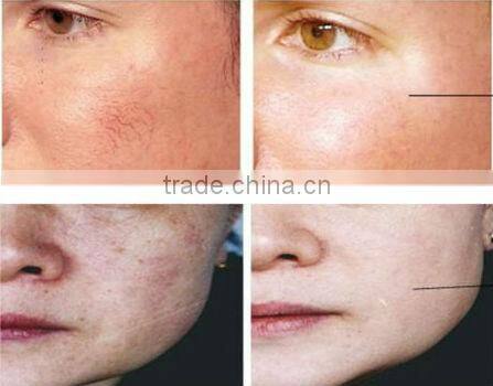 High performance !!! best fractional rf needle for sale