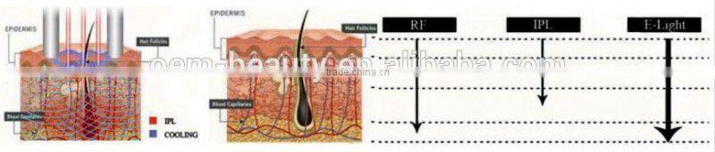 Professional Portable E-light IPL RF Hair Removal C001 with CE