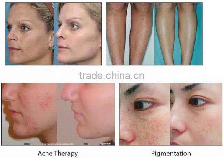 Women hair removal machine quality promise shr ipl machine