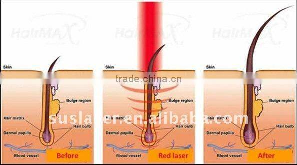 Hot Sale Best Price Red Light LED Machine For Hair Loss Treatment In India BL-002