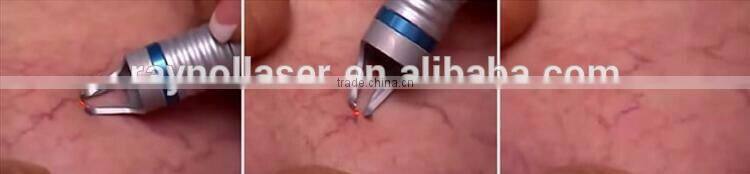 2016 Laser Diode 980nm Permanent Vascular Removal Rosacea Treatment Machine