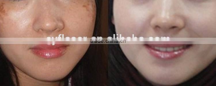 Wanted portable tattoo removal laser tattoo machine / Q-switched nd yag laser tattoo removal beauty equipment