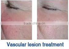 Hot selling new design professional beauty equipment shr ipl cricket score live today photofacial machine