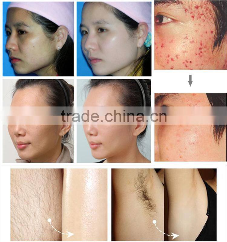 CE Approval good quality 4handles ipl shr epilator pulsed light