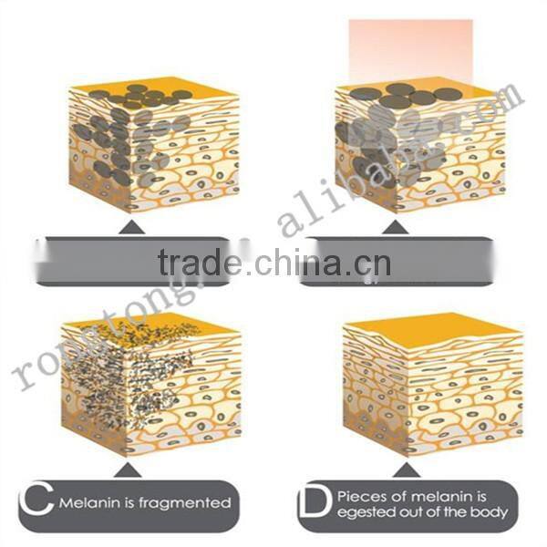 2016 beauty equipment tattoo removal Nd yag laser