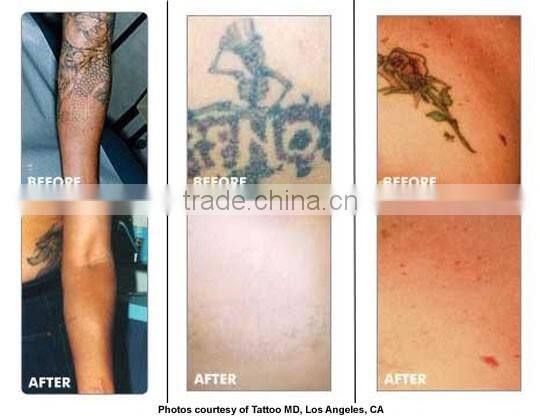 2016 OEM/ODM professional distributors wanted q switch nd yag laser tattoos removal device