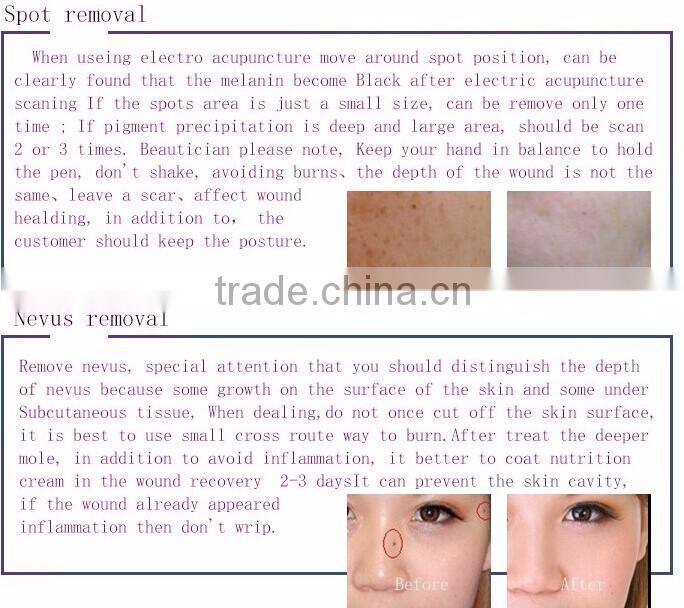 Top selling skin mole removal machine