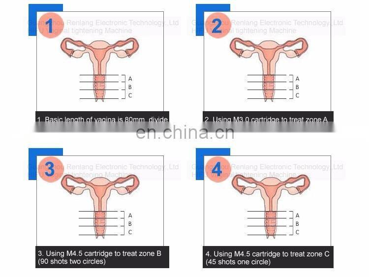 Beauty salon equipment hifu machine vaginal rejuvenation products