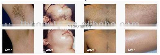 10.000.000 shot laser hair removal eyebrows