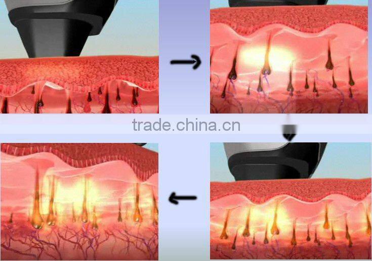 808nm/810nm diode laser hair removal lightsheer