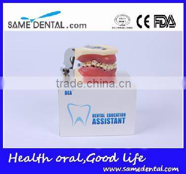 Dental Severe Periodontal Disease Model School Teaching