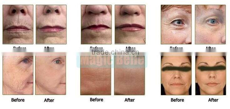 Best price Skin tightening hifu for wrinkle removal system / skin tightening machine