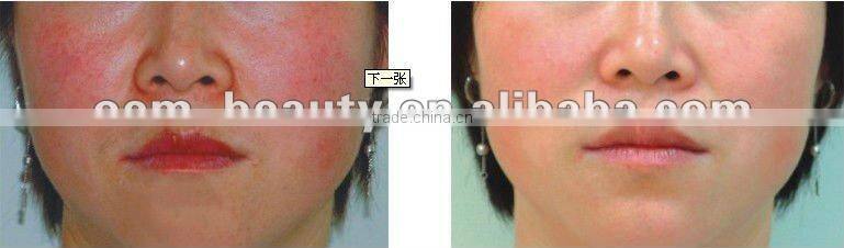 C003- Portable photon skin rejuvenation for beauty salon use