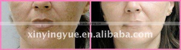 Q-switched ND:YAG pigments removal laser machine