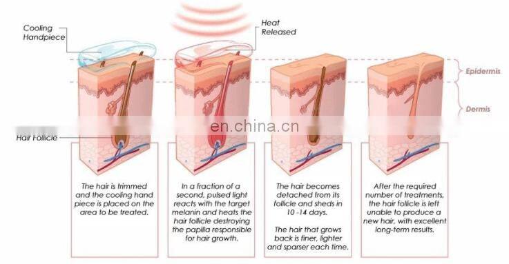 Anybeauty Beauty Machine 808nm 755nm 1064nm Diode Laser Hair Removal micro channel macro channel Machine Medical CE