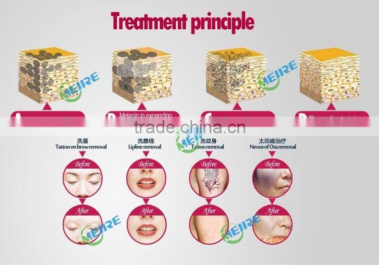 Professional mini laser tattoo removal machine