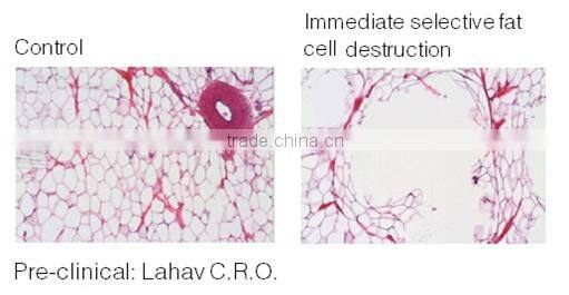 fat reduce hifu ultrason cavitation body slimming machine cellulite machine
