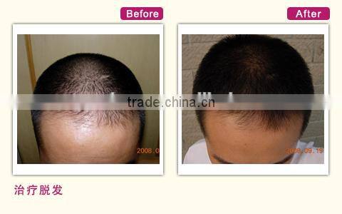 650nm diode laser hair growth head massager