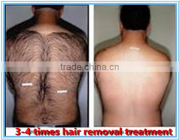 professional painless iodo laser for permanent hair removal