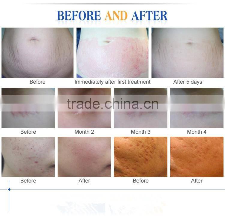 2017 Newest rechargeable microneedle nano Dr.pen with replaceable needle cartridge Ultima A6 Electric Dermapen